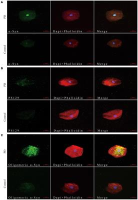 Oral Mucosa Derived α−Synuclein as a Potential Diagnostic Biomarker for Parkinson′s Disease